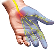 Carpal Tunnel Syndrome ABCs